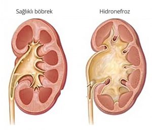 Hidronefroz - Prof. Dr. Bülent Önal